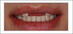 前牙美學(xué)修復(fù)種植案例2